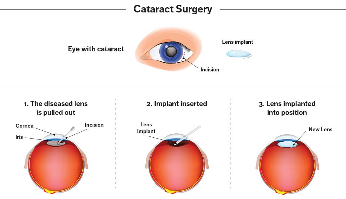 Cataract Surgery in Banagalore | Best Surgeons, best Cost